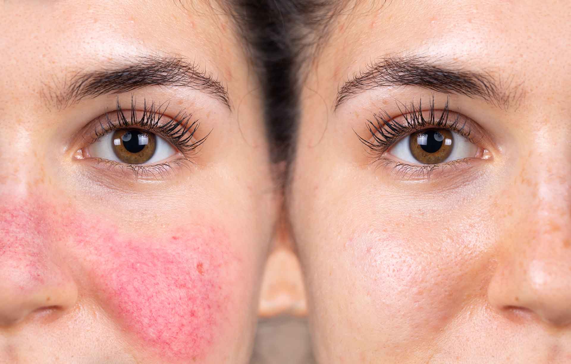 rosacea blog image