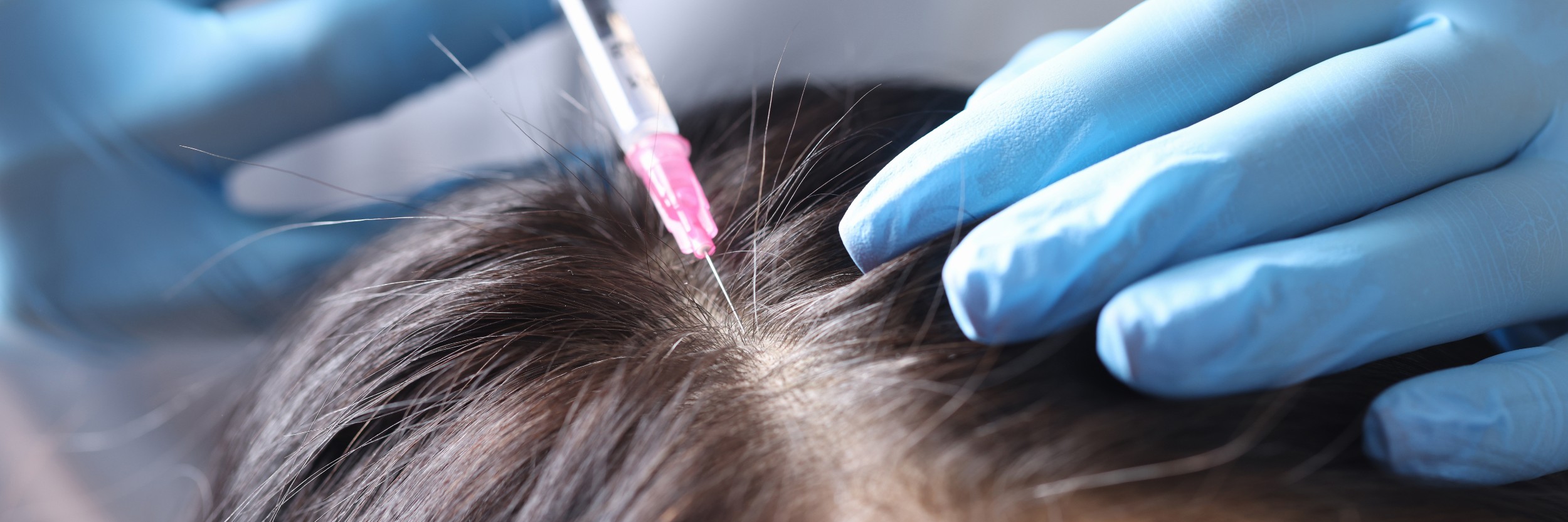 alopecia treatment edmonton