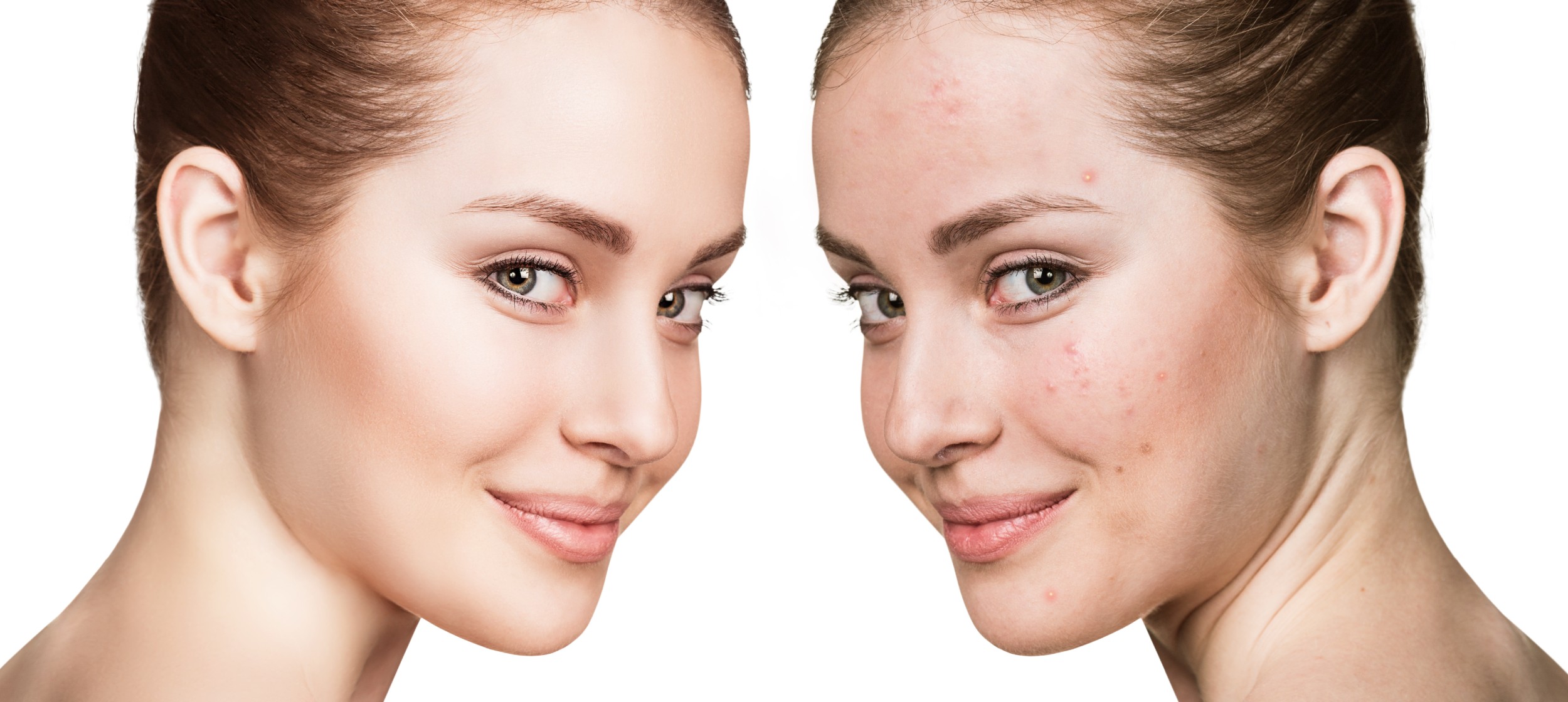 acne treatment in Edmonton