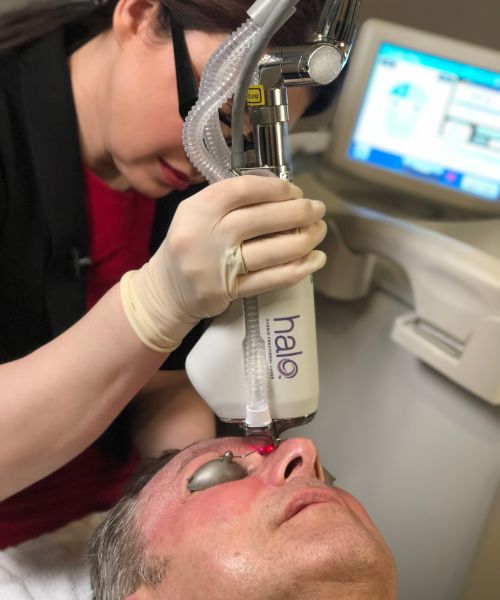 halo hybrid fractional laser treatment edmonton