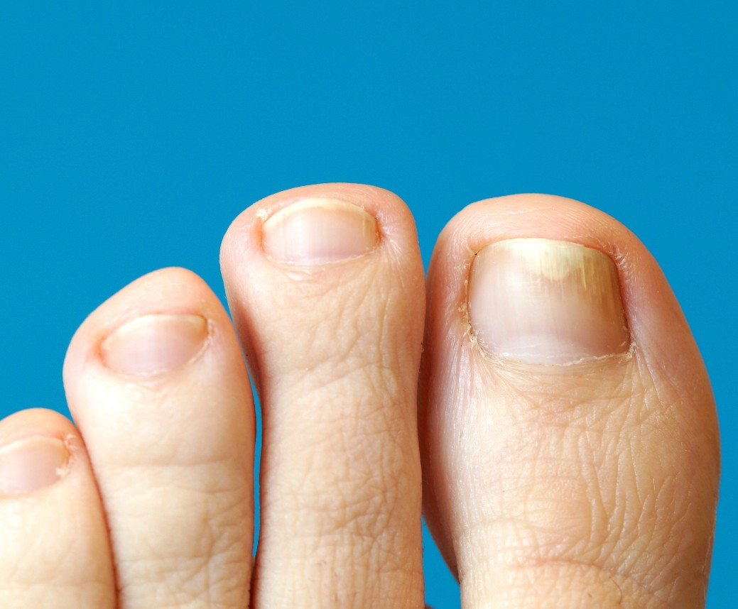 Ingrown Toe Nail  Edmonton Foot Clinic